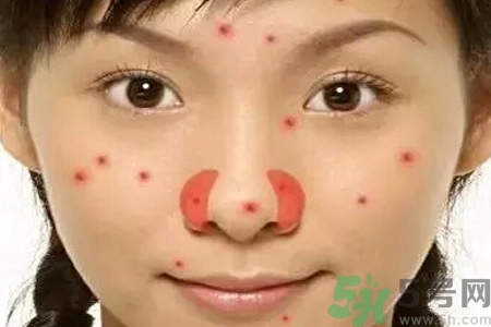 鼻翼長(zhǎng)痘痘怎么回事？鼻翼長(zhǎng)痘痘的原因是什么？