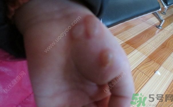 15歲還會(huì)得手足口病嗎？手足口病的癥狀有哪些？