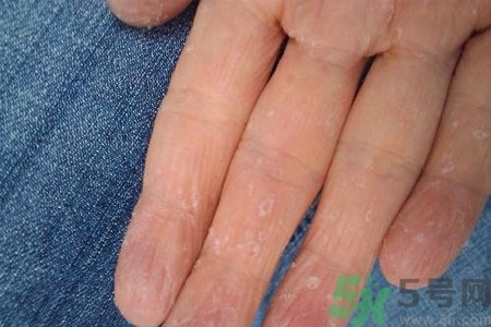 ?手掌脫皮的危害有哪些？如何預防手掌脫皮？