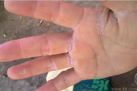 手脫皮是什么原因？手脫皮的治療方法是什么？