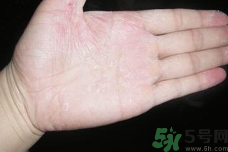 手脫皮是什么原因？手脫皮的治療方法是什么？