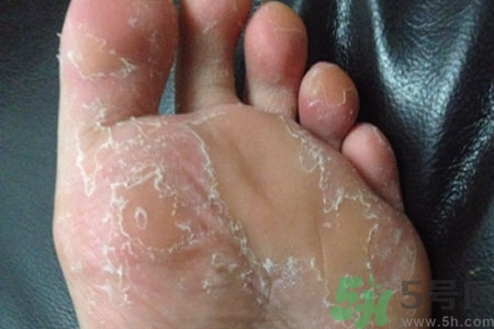 腳脫皮是怎么回事？腳脫皮怎么辦？