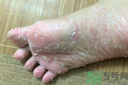 腳脫皮的治療方法有哪些？如何預(yù)防腳脫皮？