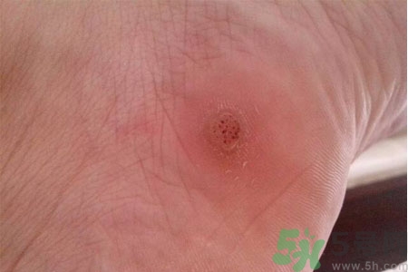 腳上長雞眼是怎么回事？腳上長雞眼是怎么辦？