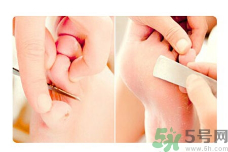 雞眼怎么能徹底根治？如何預(yù)防腳上長雞眼？
