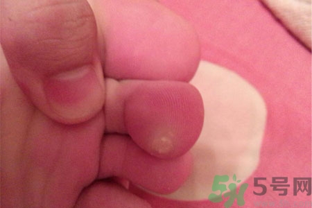雞眼怎么能徹底根治？如何預(yù)防腳上長(zhǎng)雞眼？