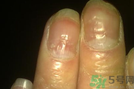 孩子手指甲凹凸不平是什么原因？手指甲凹凸不平的原因是什么？