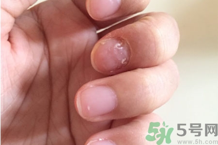 孩子手指甲凹凸不平是什么原因？手指甲凹凸不平的原因是什么？