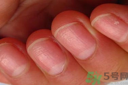 手指甲凹凸不平是怎么回事？如何預(yù)防手指甲凹凸不平？
