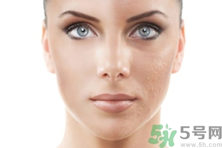 激光縮毛孔多少錢(qián)一次？激光縮毛孔一個(gè)療程多少錢(qián)？