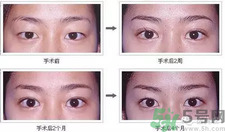 提眉術(shù)后多久可以恢復(fù)？提眉術(shù)后全過程照片