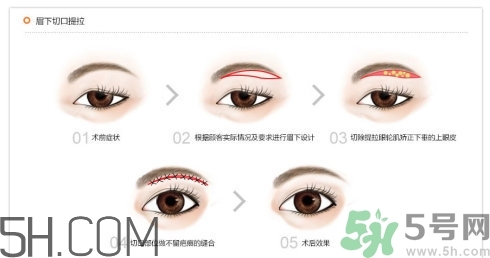 切眉手術后老得快嗎？切眉能保持多久？