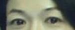 提眉術(shù)后多久可以恢復(fù)？提眉術(shù)后全過程照片