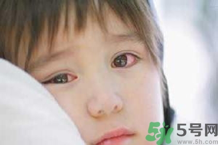 流行性腮腺炎的表現(xiàn)有哪些？?流行性腮腺炎飲食怎么調(diào)理？