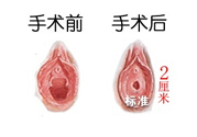 處女膜修補(bǔ)術(shù)效果怎么樣？處女膜修復(fù)手術(shù)有風(fēng)險(xiǎn)嗎？