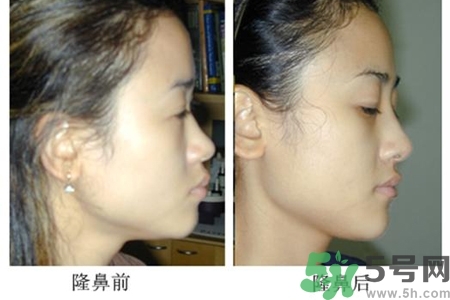 玻尿酸隆鼻的危害有哪些？玻尿酸隆鼻的副作用是什么？
