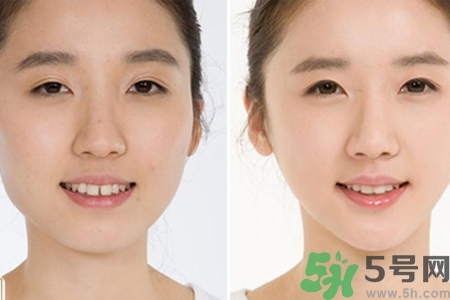 玻尿酸隆鼻的缺點(diǎn)是什么？玻尿酸隆鼻的優(yōu)點(diǎn)有哪些？