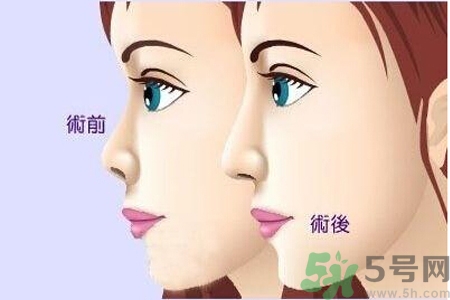 玻尿酸隆鼻和手術(shù)隆鼻的區(qū)別是什么？