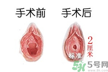 什么人不能做處女膜修補(bǔ)術(shù)？處女膜修補(bǔ)術(shù)會(huì)留疤嗎？