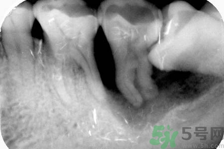 拔智齒一顆多少錢？拔除智齒收費(fèi)多少？