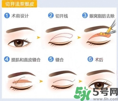 雙眼皮手術(shù)哪種最好？割雙眼皮后注意些什么？