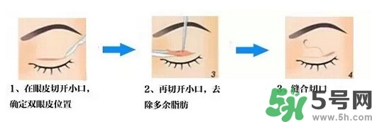雙眼皮手術(shù)哪種最好？割雙眼皮后注意些什么？