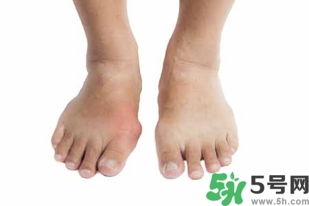 引發(fā)痛風(fēng)的原因是什么？痛風(fēng)病人飲食需注意什么好？