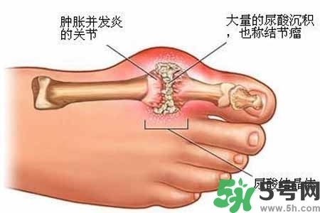 引發(fā)痛風(fēng)的原因是什么？痛風(fēng)病人飲食需注意什么好？