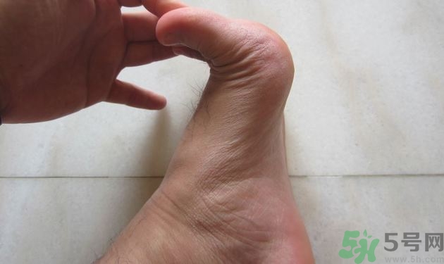 腳拇指外翻遺傳嗎？腳拇指外翻怎么矯正？