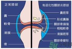 骨關(guān)節(jié)炎能治好嗎？骨關(guān)節(jié)炎平時注意事項