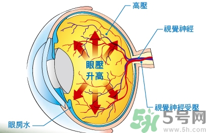 青光眼可以治愈嗎？青光眼怎樣治療？