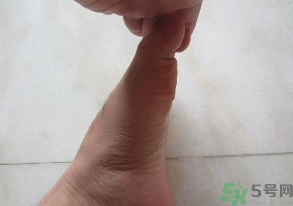 腳拇指外翻遺傳嗎？腳拇指外翻怎么矯正？