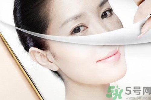 曬斑可以自己消退嗎？曬斑可以用激光去除嗎？
