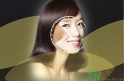 曬斑可以自己消退嗎？曬斑可以用激光去除嗎？