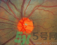 青光眼可以治愈嗎？青光眼怎樣治療？