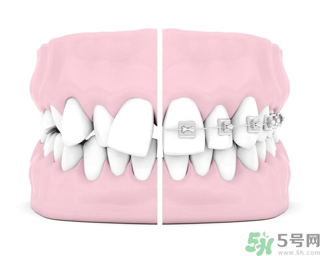 牙齒橫著長(zhǎng)怎么辦？智齒橫著長(zhǎng)一定要拔嗎？