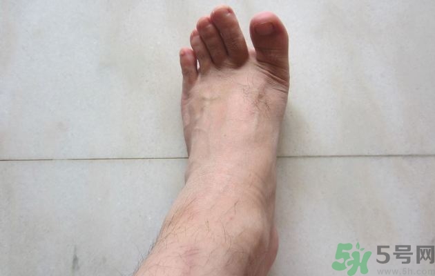 腳拇指外翻遺傳嗎？腳拇指外翻怎么矯正？