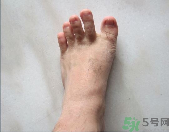 腳拇指外翻遺傳嗎？腳拇指外翻怎么矯正？