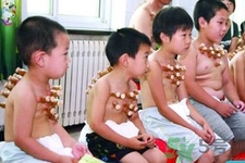 小孩可以拔罐嗎？寶寶能拔火罐嗎？
