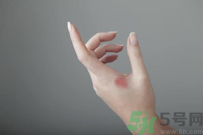手被燙紅了怎么辦？手被燙了怎么止痛？