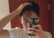 頭痛可以在額頭上拔火罐嗎？額頭上拔火罐有什么好處？