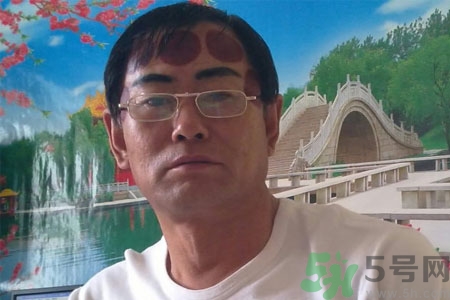頭痛可以在額頭上拔火罐嗎？額頭上拔火罐有什么好處？