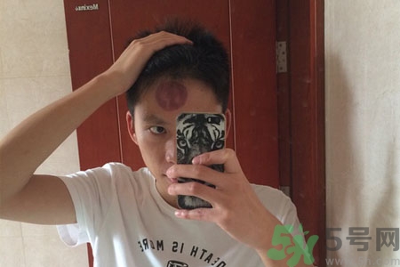 頭痛可以在額頭上拔火罐嗎？額頭上拔火罐有什么好處？