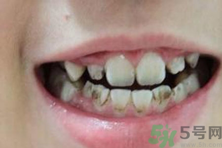 小孩牙齒發(fā)黑怎么回事？小孩牙齒發(fā)黑怎么辦？