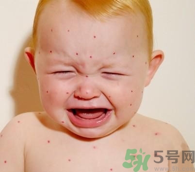 新生兒濕疹怎么引起的？新生兒濕疹如何處理？