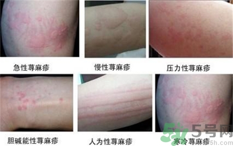 蕁麻疹有幾種類(lèi)型?蕁麻疹類(lèi)型對(duì)照?qǐng)D