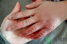 患凍瘡用溫水泡最好嗎？患凍瘡用熱水泡還是冷水泡好？
