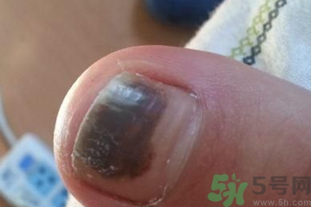 腳趾甲變黑是什么原因？腳趾甲變黑是怎么回事？