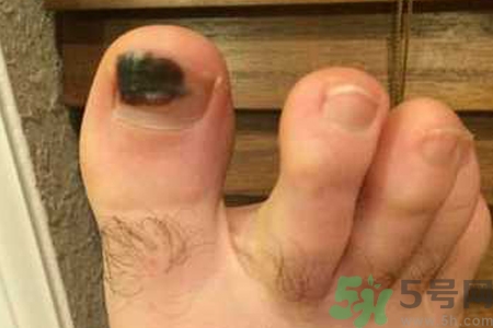 腳趾甲變黑是什么原因？腳趾甲變黑是怎么回事？