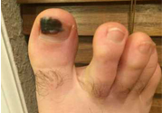 腳趾甲變黑是什么原因？腳趾甲變黑是怎么回事？